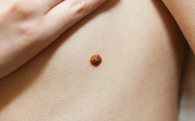 big-birthmark-on-the-girl-s-skin-medical-health-p-2026-01-11-08-10-52-utc