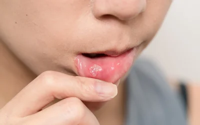 close-up-of-woman-with-aphtha-2026-01-09-07-40-00-utc
