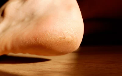 cracked-and-dry-heel-of-the-foot-skin-2026-01-05-06-10-37-utc