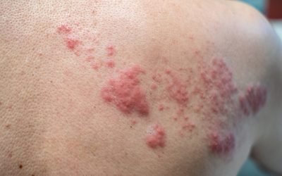 shingles-disease-herpes-zoster-varicella-zoste-2026-01-09-06-10-35-utc (1)