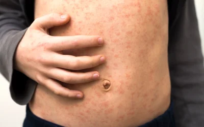 sick-child-body-stomach-with-red-rush-spots-from-2026-01-06-09-58-17-utc